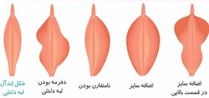 عمل زیبایی واژن