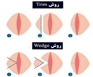 عمل زیبایی واژن