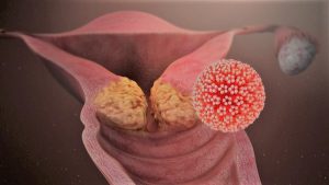 زگیل تناسلی خفیف