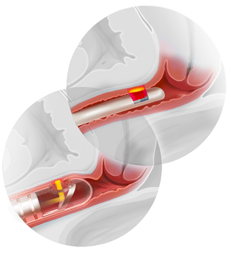 Vaginal-infection-laser